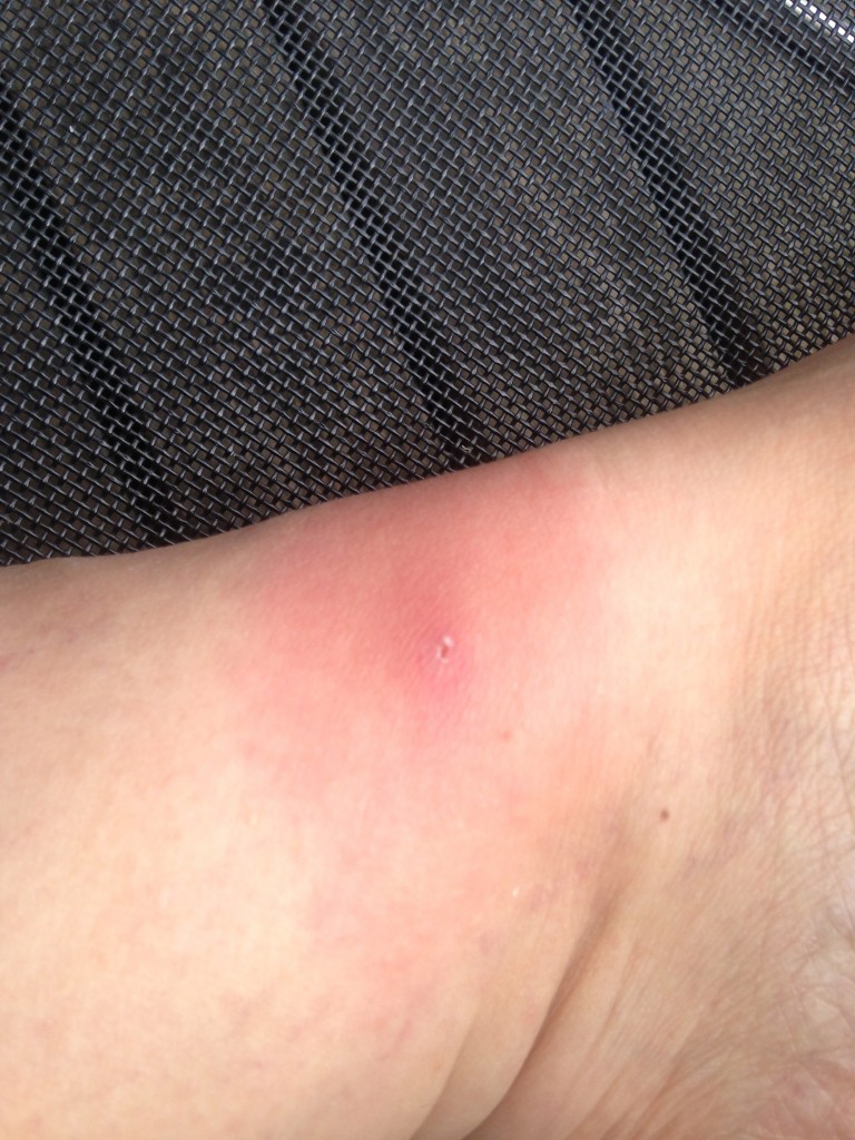 Wanderröte bei der Borreliose